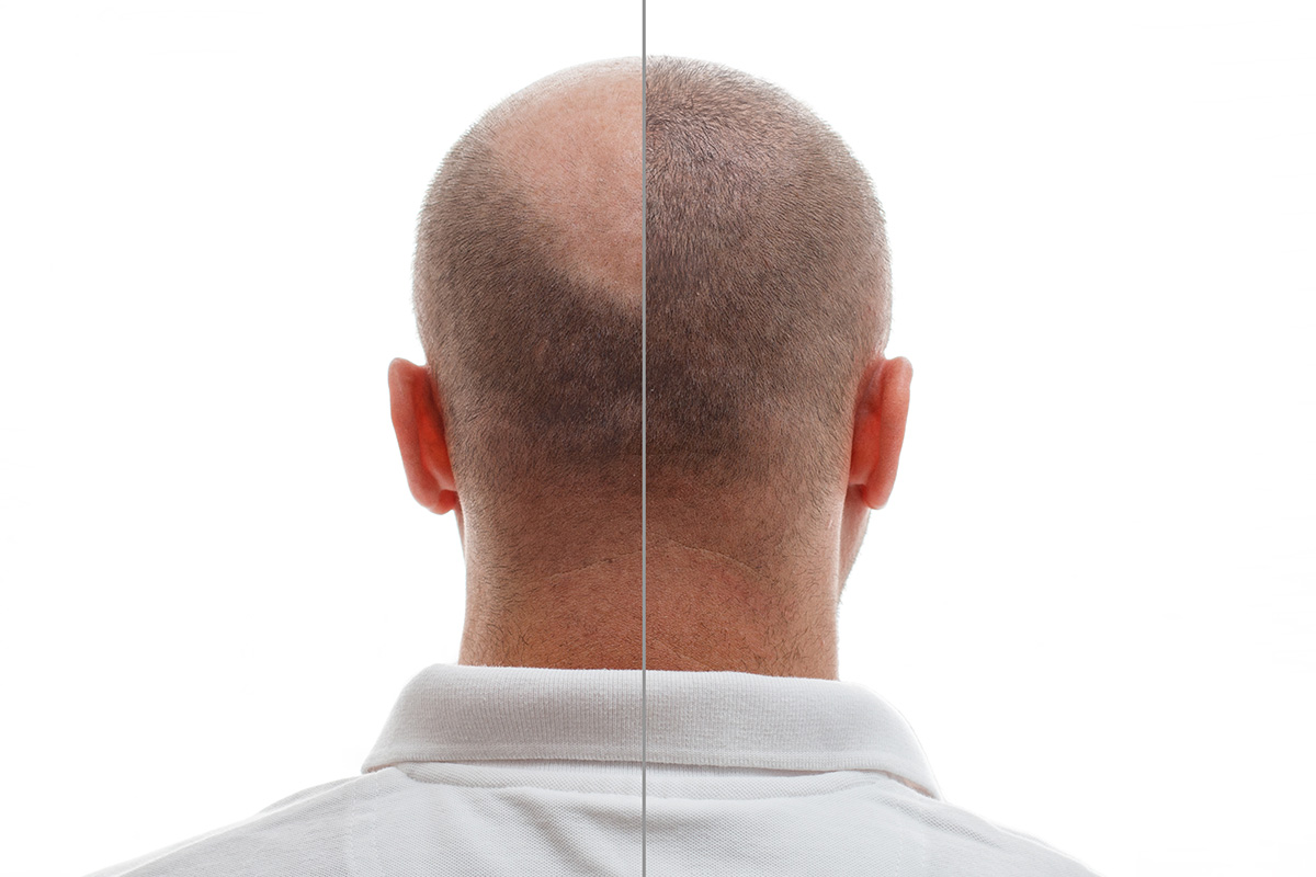Hair Transplantation: A Quick Overview
