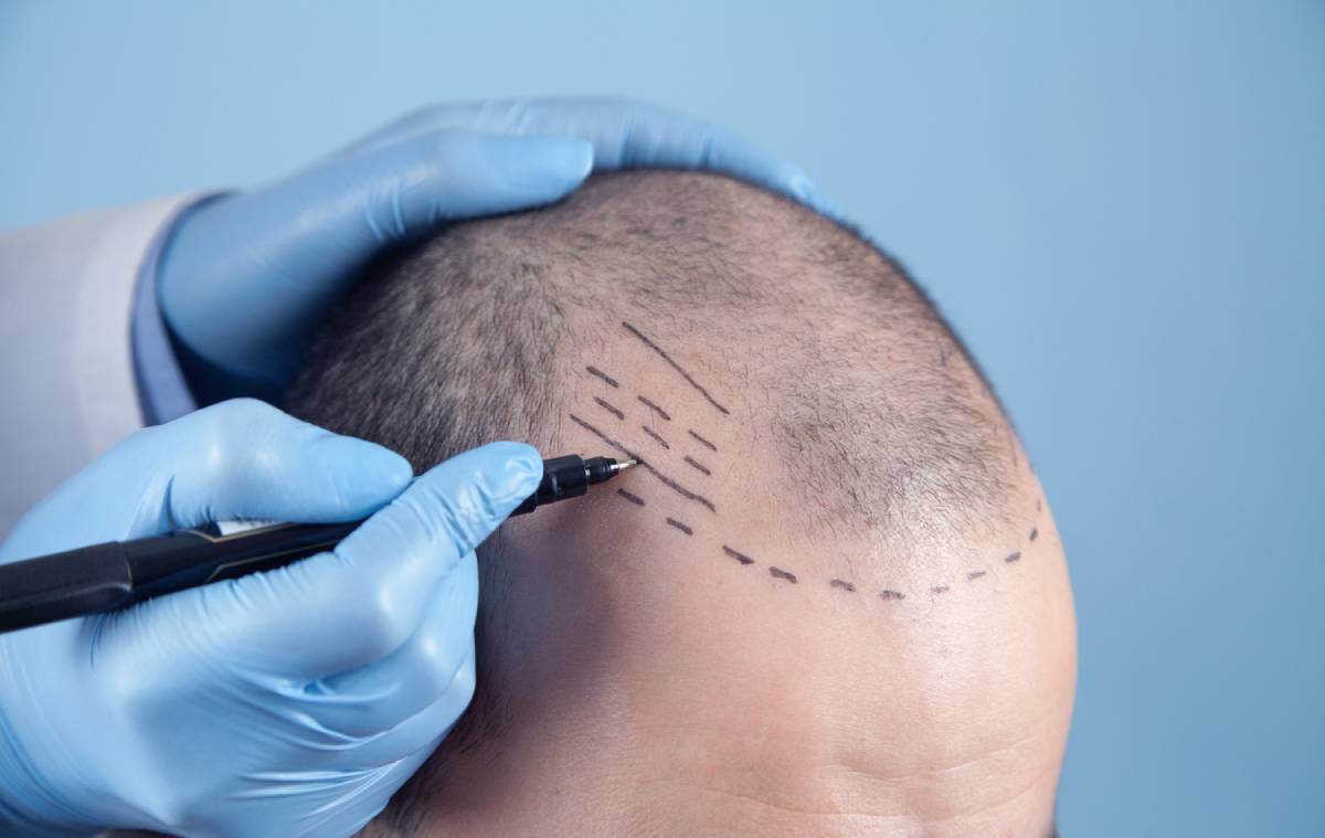 Hair Transplant Myths: What’s True and What’s Not?
