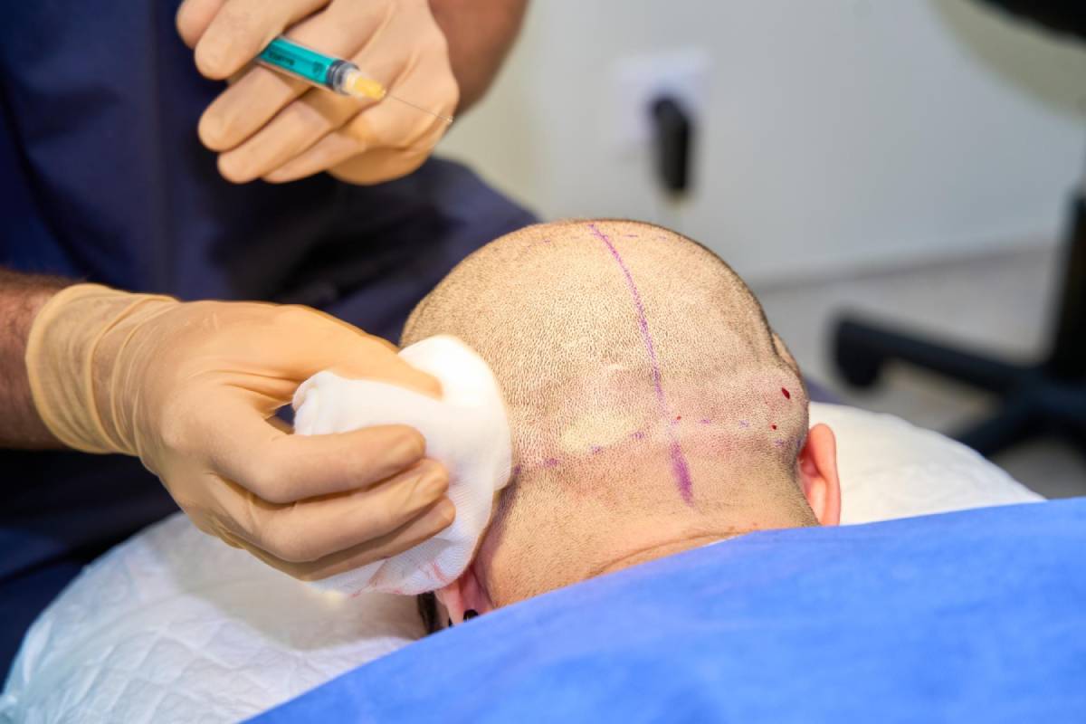 FUE vs. FUT: Which Hair Transplant is Better?