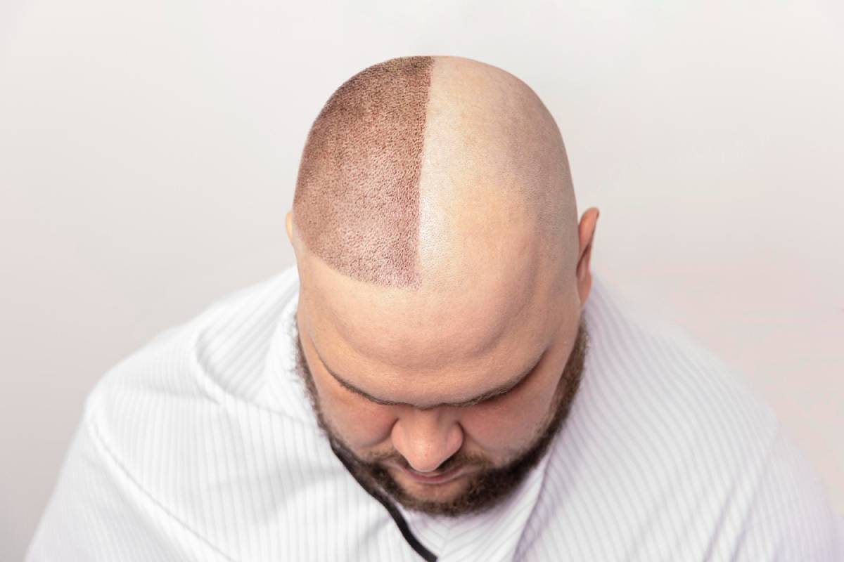 Bald Spots Gone: How Fast Do Transplants Work?