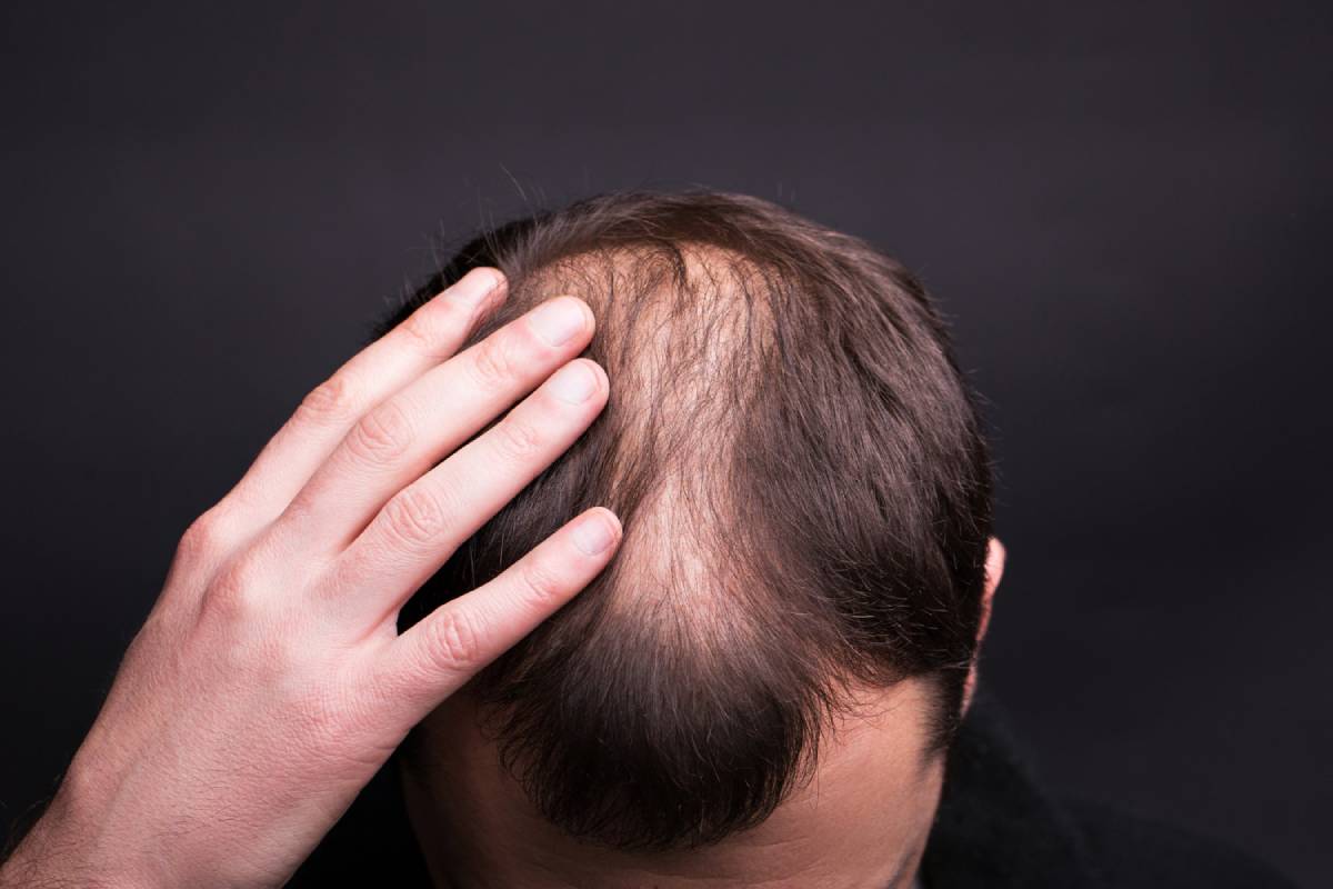 Hair Transplantation: Benefits and Recovery Explained