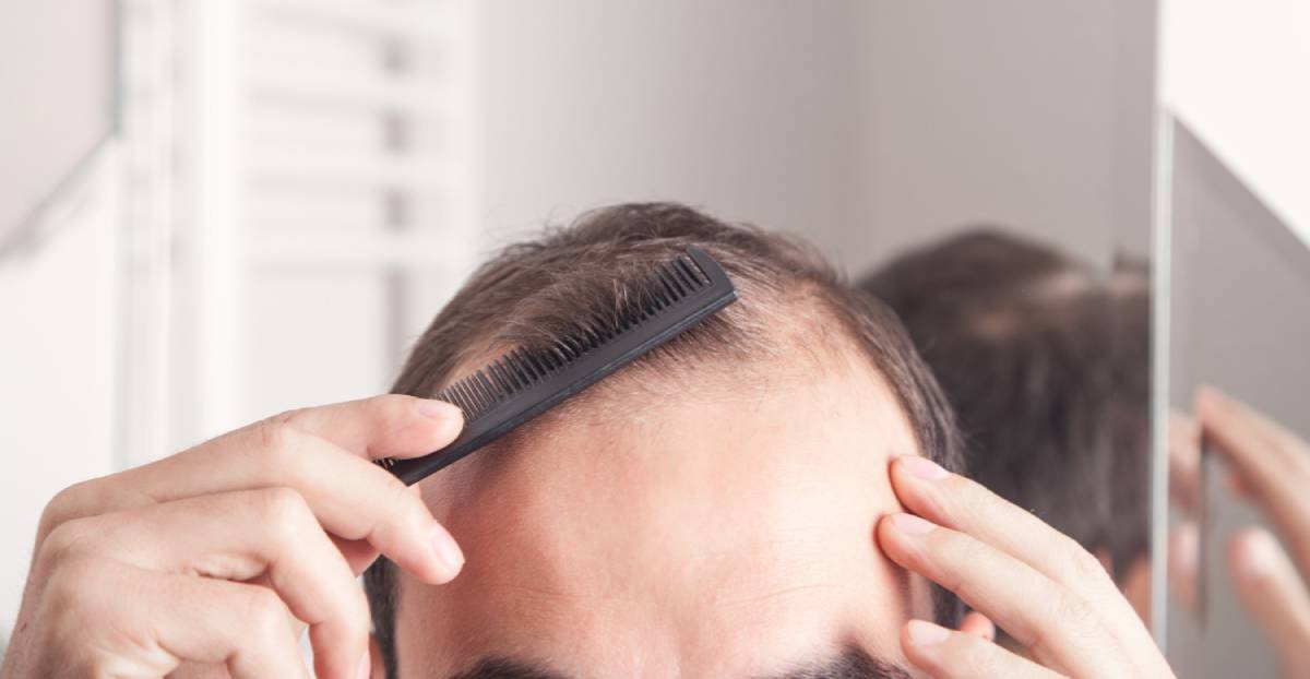 The Best Candidates for Hair Transplantation Surgery