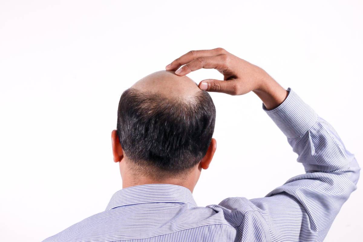 Hair Transplantation Costs: What You Need to Know