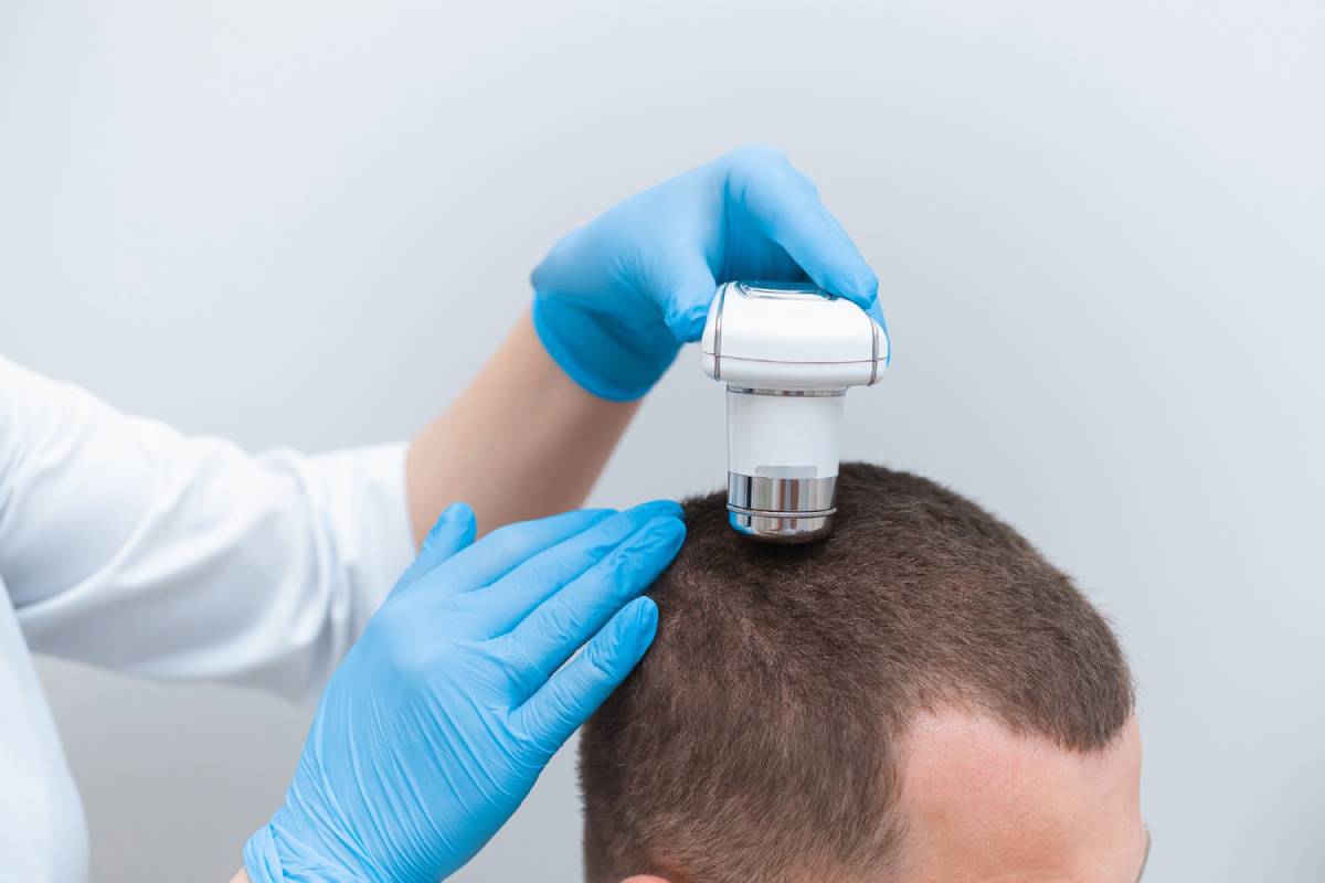 What to Expect from a Hair Transplantation Procedure