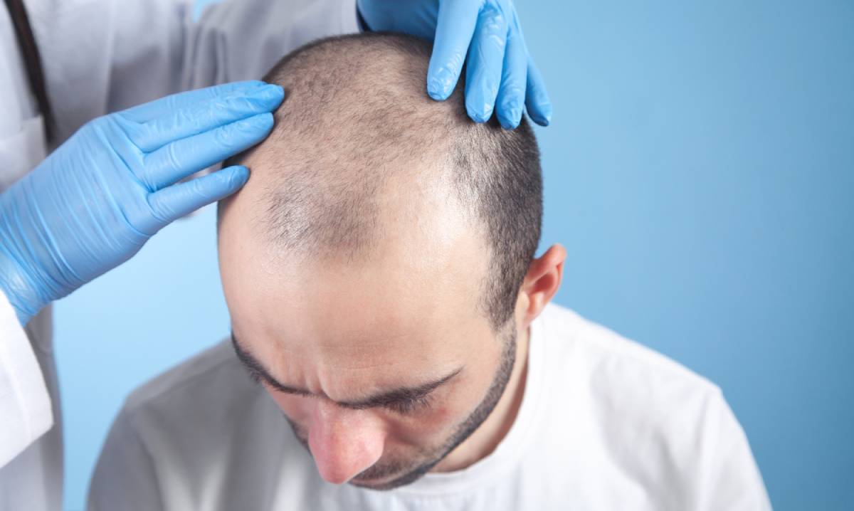 Is Hair Transplantation Right for You?