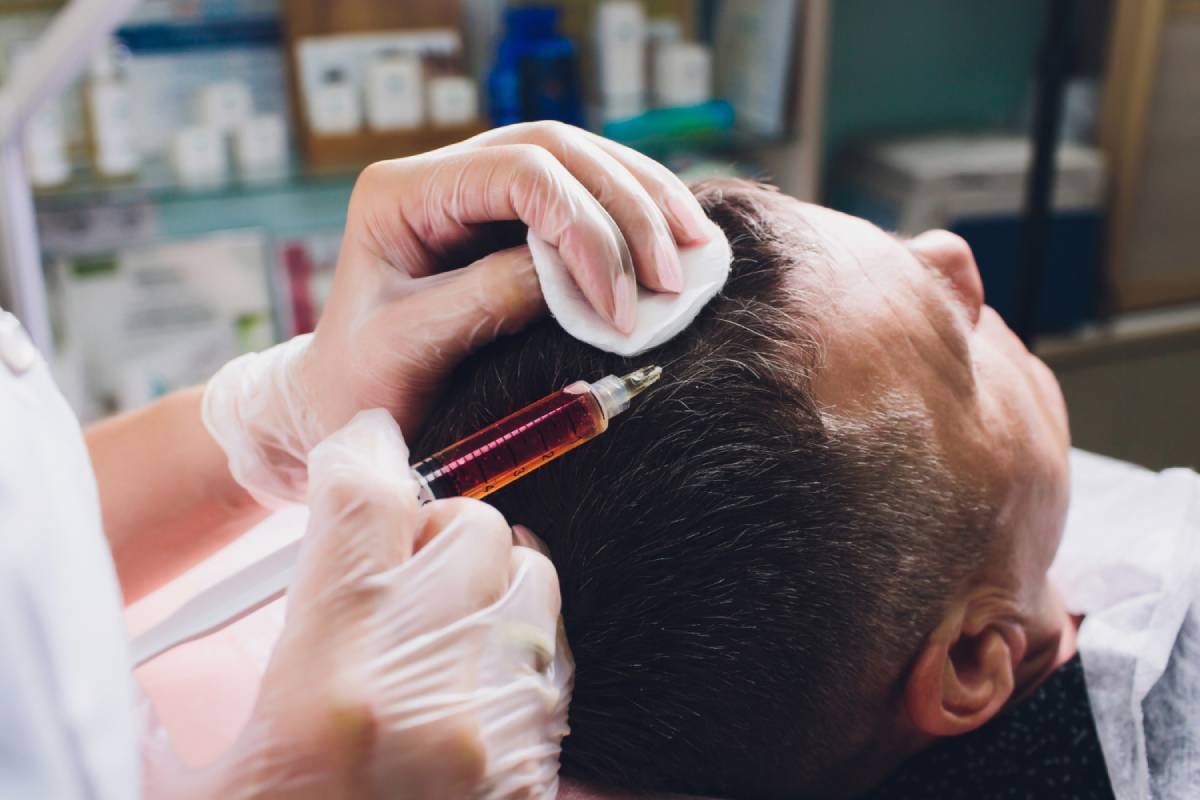 Hair Transplantation: What to Expect Before and After