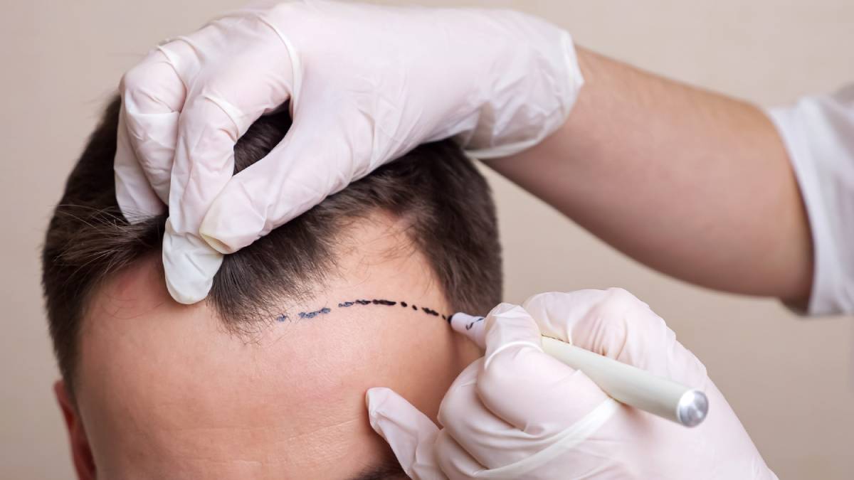 How Hair Transplantation Can Restore Your Natural Look