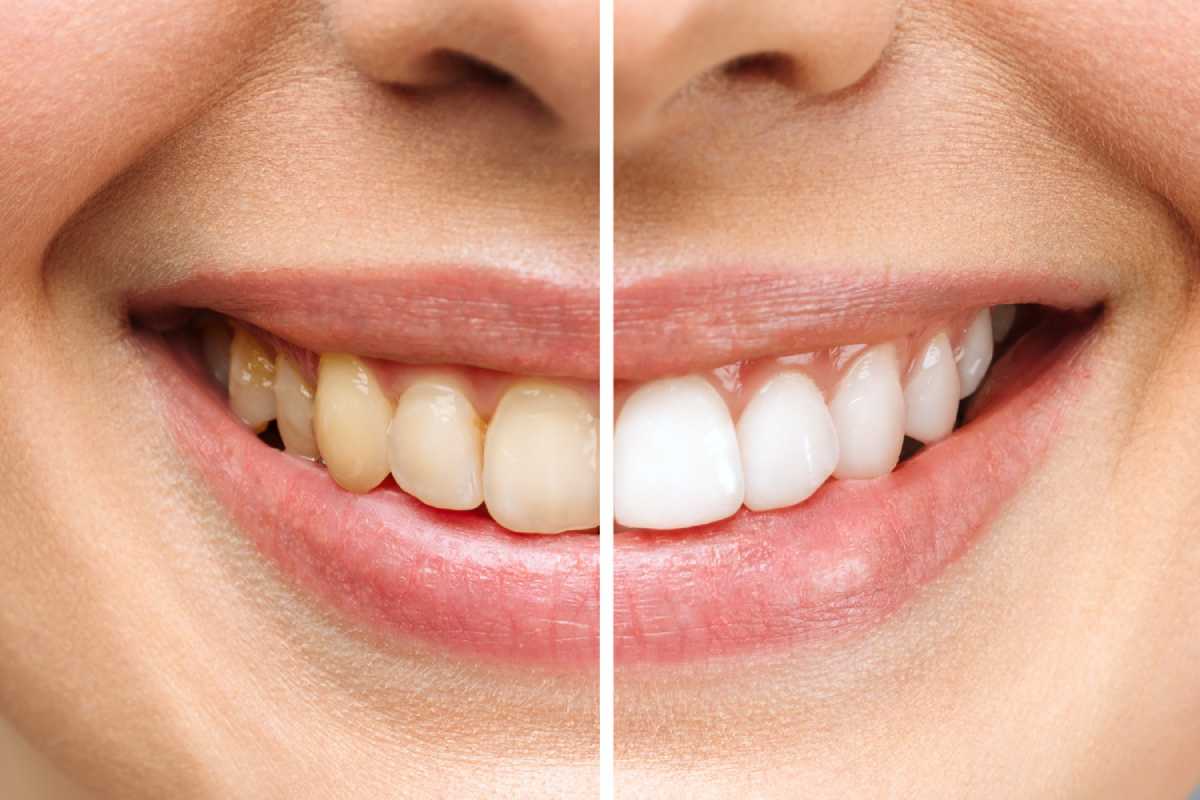 Is Teeth Whitening Safe and Effective?