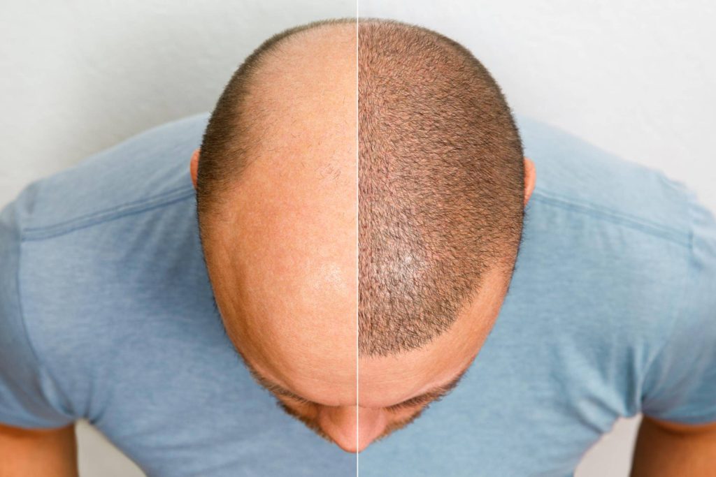 How Hair Transplantation Can Restore Your Confidence