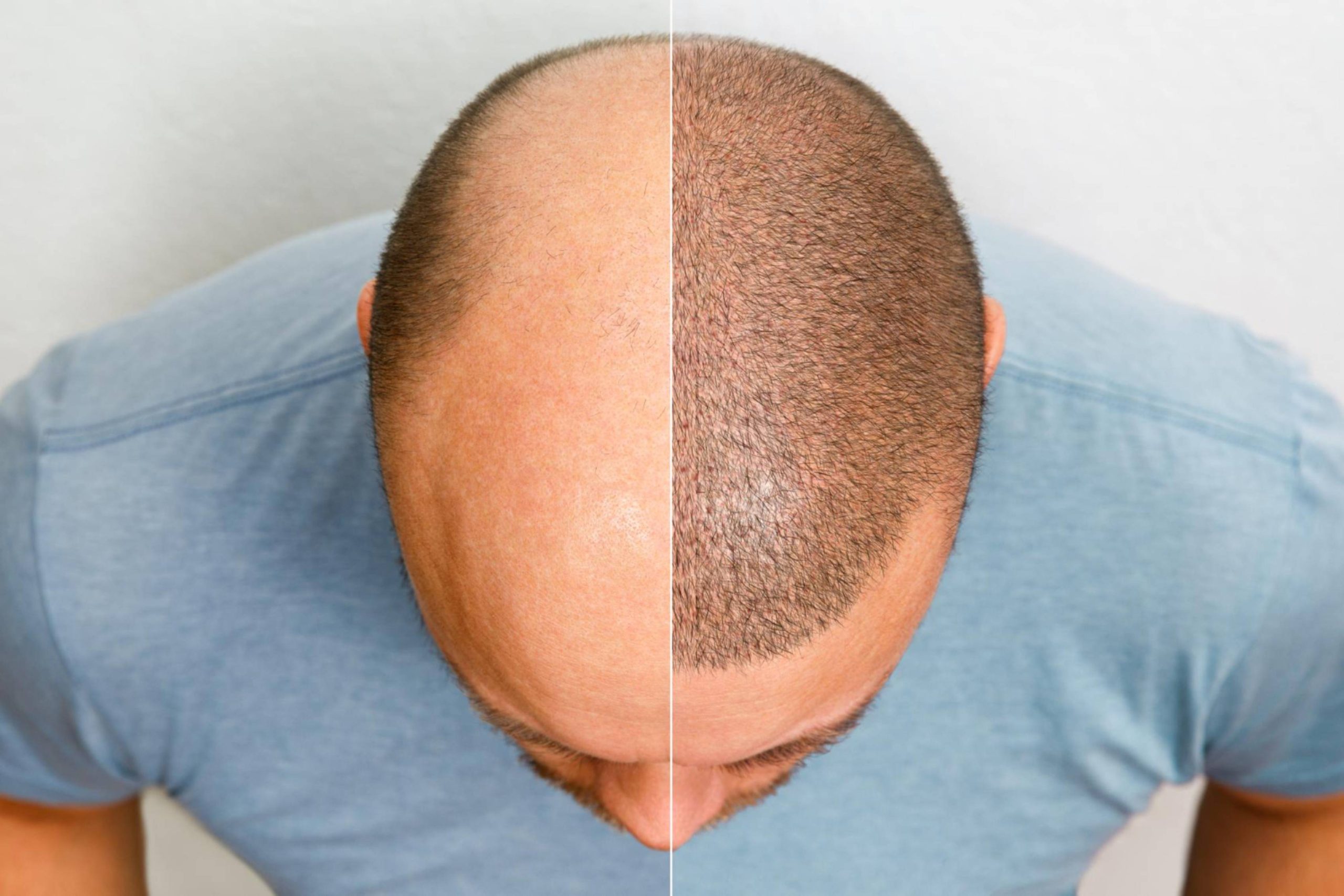 How Hair Transplantation Can Restore Your Confidence