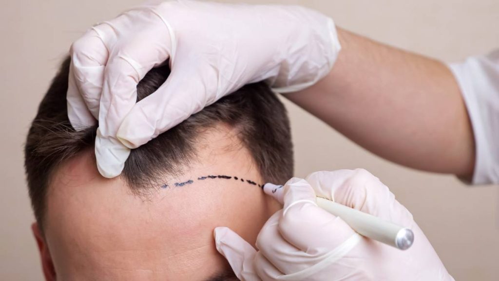 Hair Transplantation for Thinning Hair: A Permanent Solution