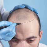 Why Hair Transplantation Is the Best Choice for Baldness