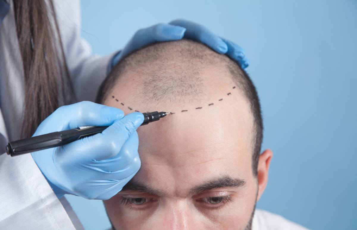 Why Hair Transplantation Is the Best Choice for Baldness