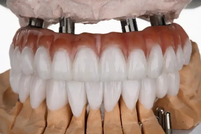 All-on-4 Dental Implants: A Permanent Solution for Full-Mouth Restoration
