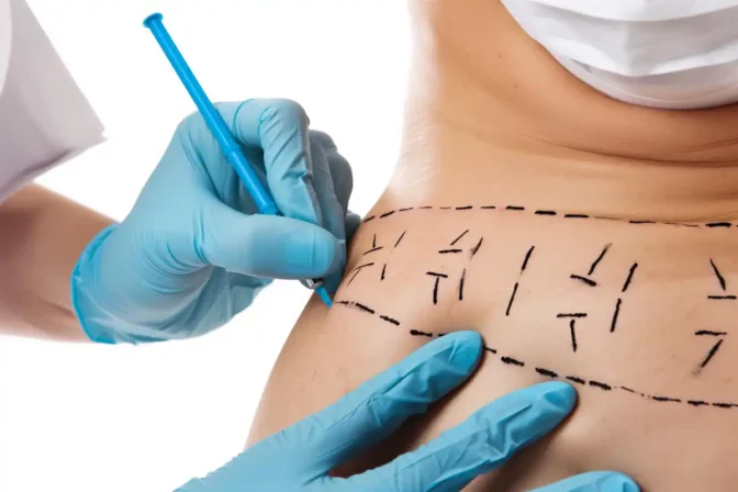 Safe and Fast Obesity Surgery