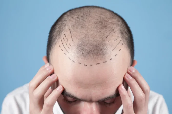 Modern Hair Transplantation & Advanced Structural Restoration Guide