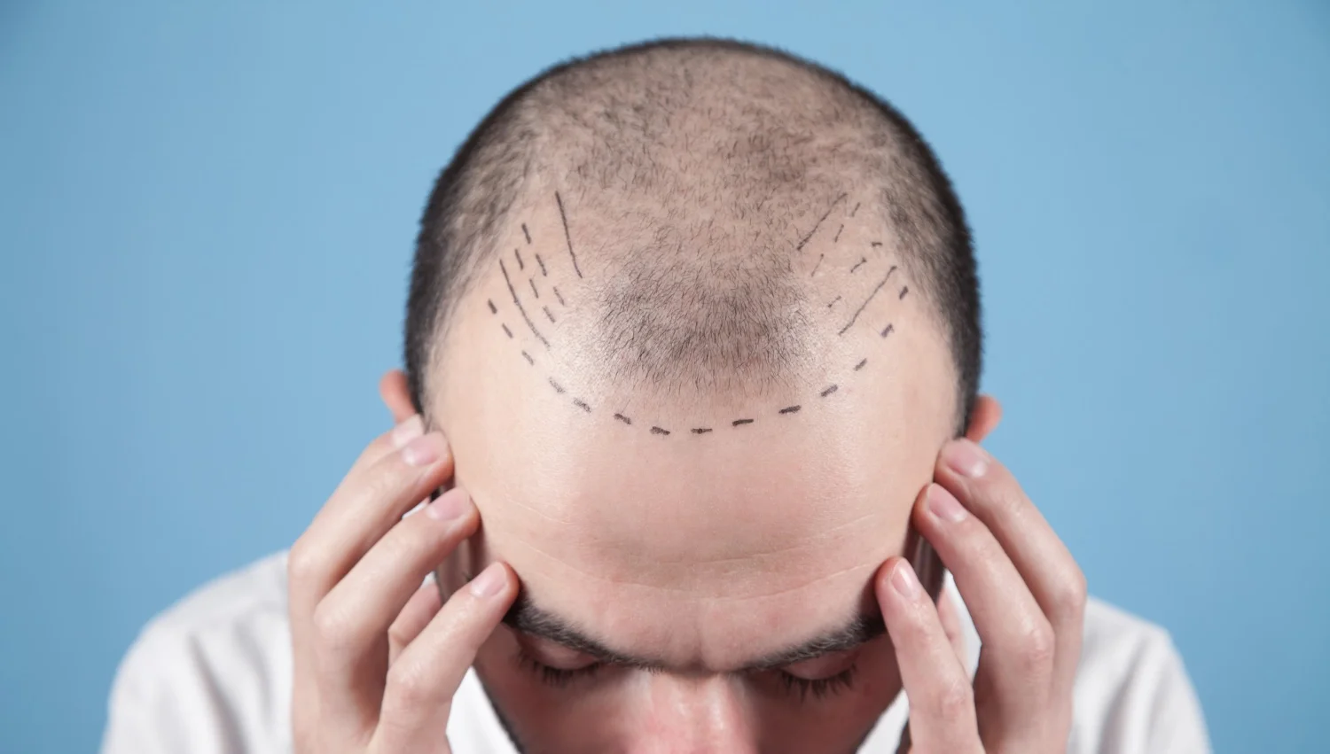 Modern Hair Transplantation & Advanced Structural Restoration Guide